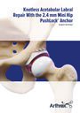 Acetabular Labral Repair using the PushLock® Knotless Anchor System