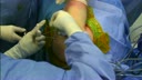 SpeedBridge™ Rotator Cuff Repair with Medial Double Pulley